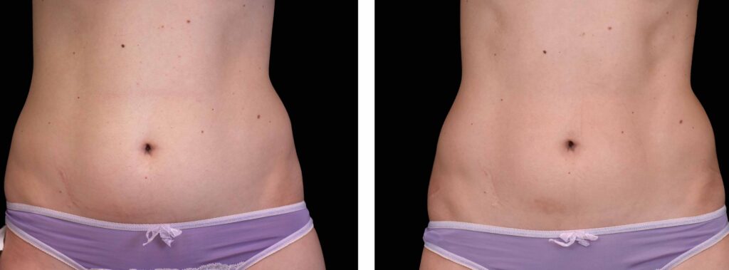 emsculpt before after01 emsculpt before after01