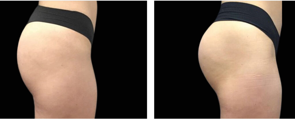 emsculpt before after02 emsculpt before after02