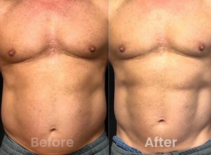 emsculpt before after03 emsculpt before after03