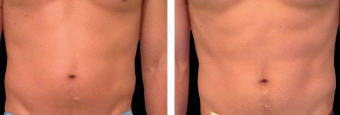 emsculpt before after04 emsculpt before after04