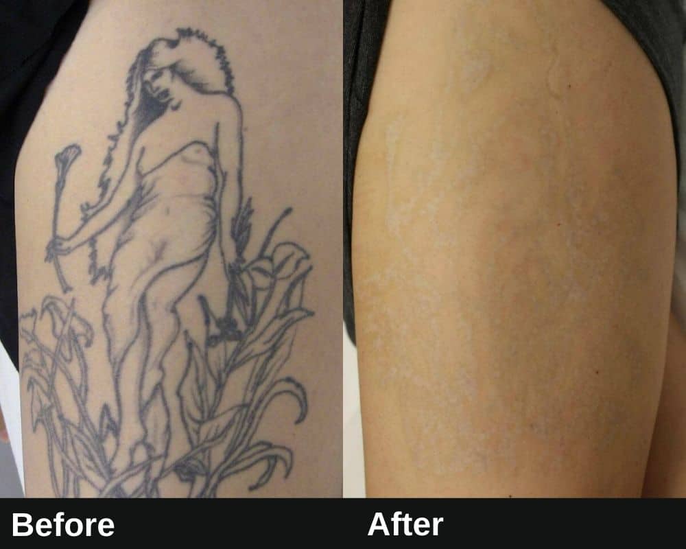 laser tattoo removal before and after losangeles 2