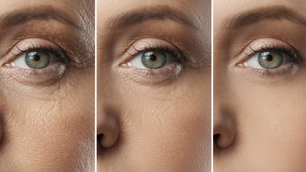 rf microneedling 1 980x551 rf microneedling 1 980x551